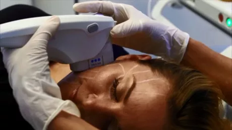 Ultherapy at Santé Aesthetics & Wellness: The Non-Surgical Solution for Firm, Youthful Skin